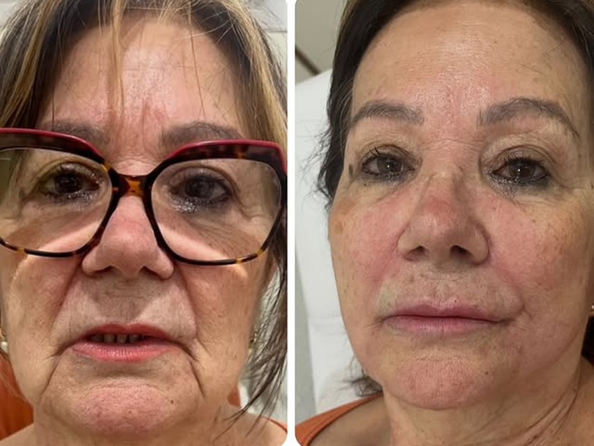 Caso Sem filtro publicado por Tiago Brasil: fotos reais da paciente antes e depois